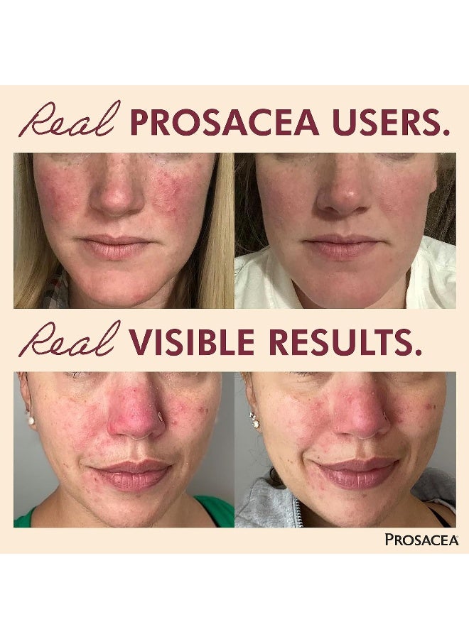 Prosacea Rosacea Gel - Image 2